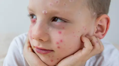 What is chickenpox and how can I get my child vaccinated?